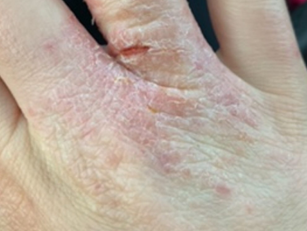 eczeem hand