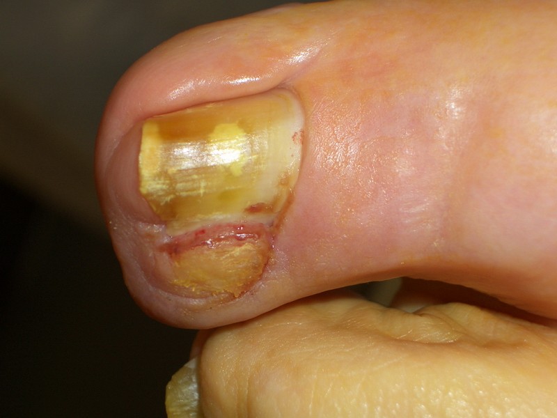 We zien een ingegroeide teennagel het vaakst aan de hallux (grote teen).