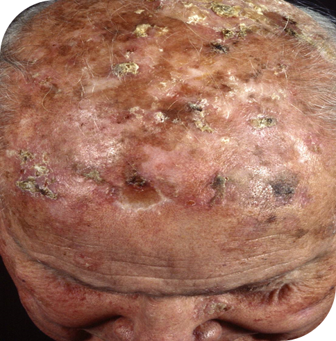 Actinische keratose