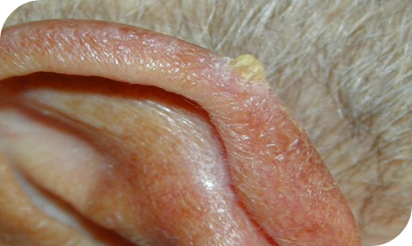 Actinische keratose op de oorschelp
