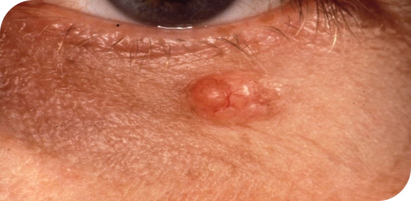 Basaalcelcarcinoom onder het oog