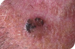 Gepigmenteerd basaalcelcarcinoom