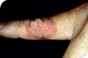 Morbus Bowen op de vinger