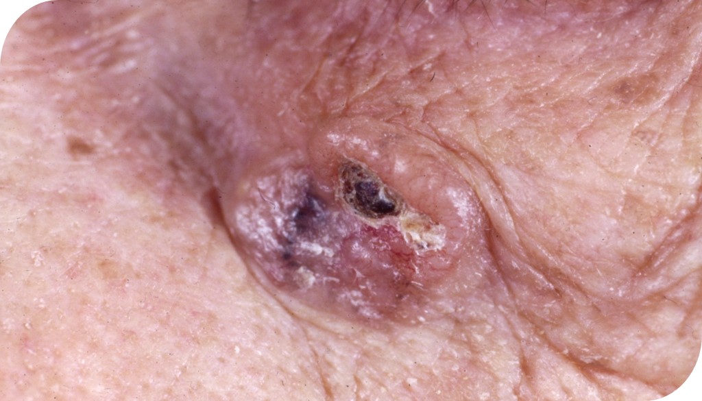 Nodulair basaalcelcarcinoom