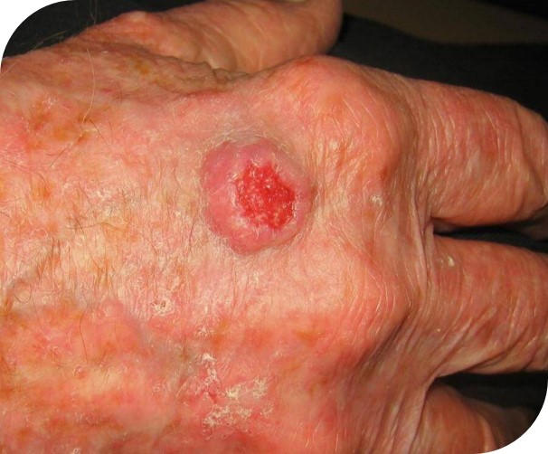 Plaveiselcelcarcinoom op de handrug