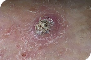 Plaveiselcelcarcinoom