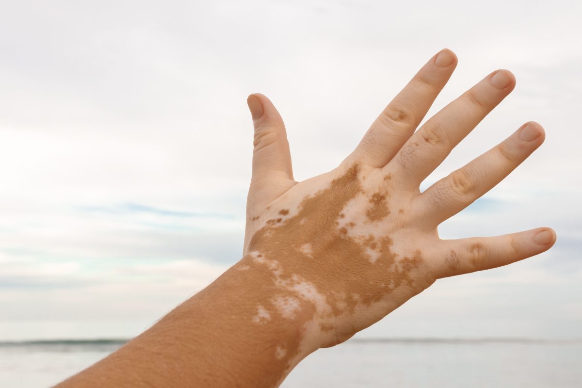 vitiligo